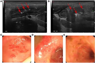 Acute Ulcerative Enterocolitis With Severe Protein Loss Due to Mucosal Invasion With Enterococcus spp. in a Dog With Exocrine Pancreatic Insufficiency: A Case Report